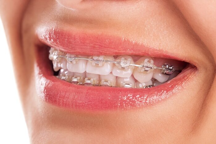 Perfect teeth with braces isolated